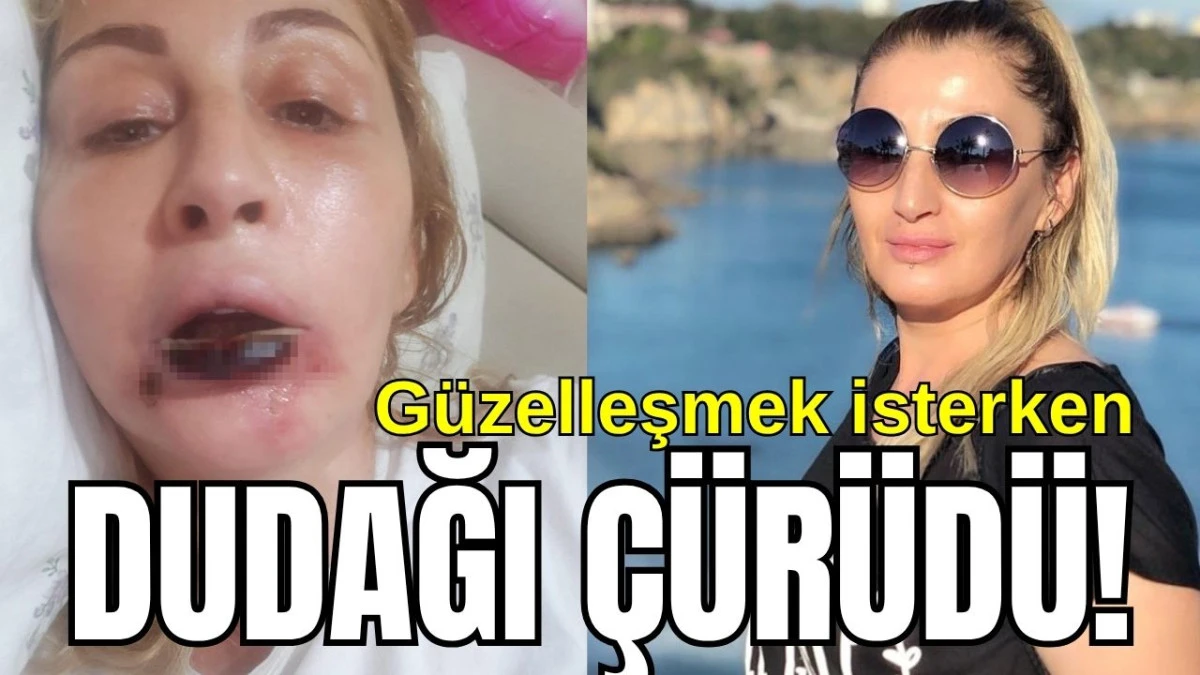 Antalya'da g&uuml;zelleşmek isterken dudağı &ccedil;&uuml;r&uuml;d&uuml;!
